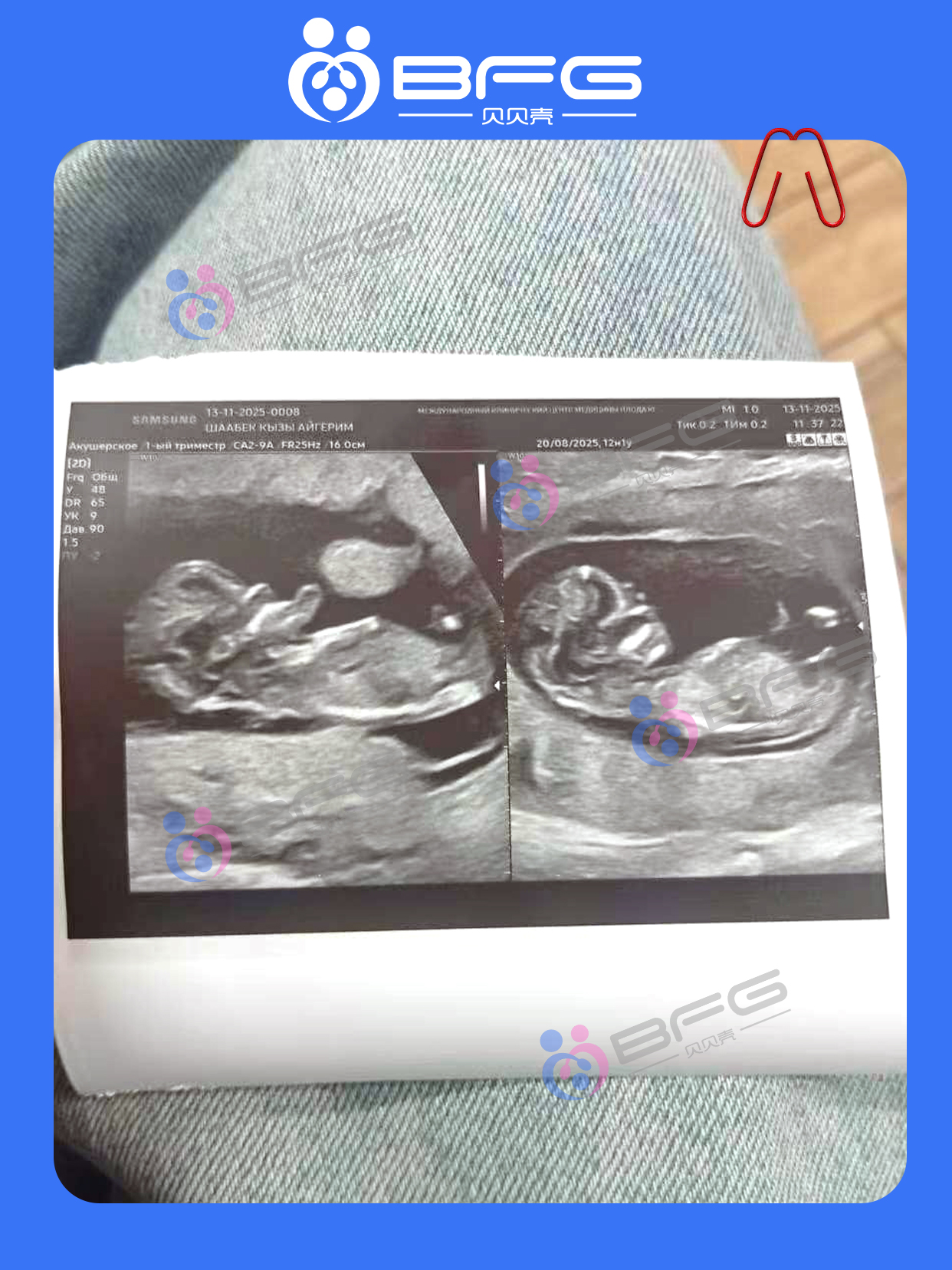 BFG好孕传递 | 12周的双胎妈妈建档啦