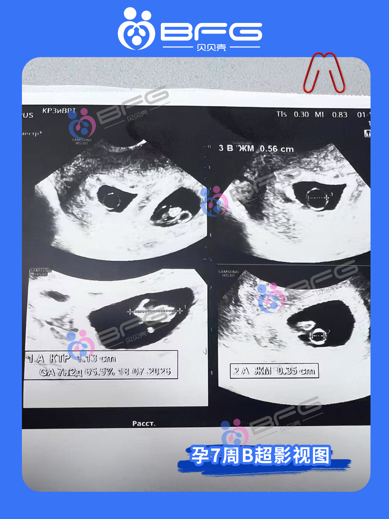 BFG吉国助孕 | 接12月的第一波好孕
