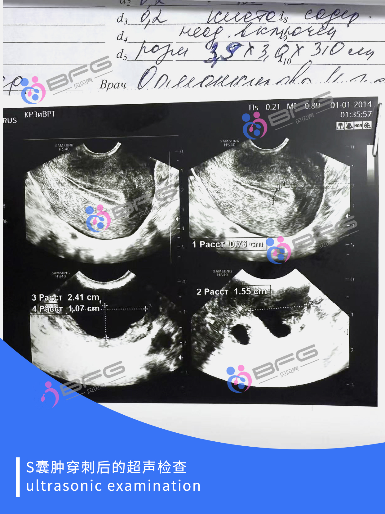 BFG助孕|年底好孕爆棚，6个❤妈妈准备中