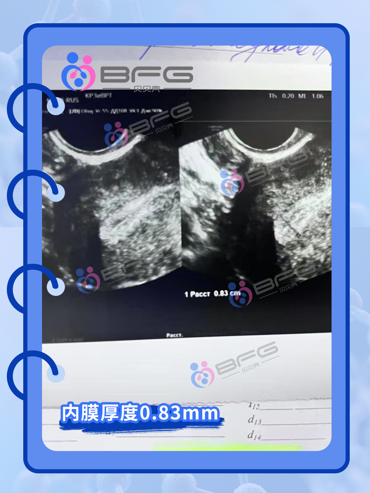 BFG吉国助孕 | 定了，❥(^_-)妈妈马上移植