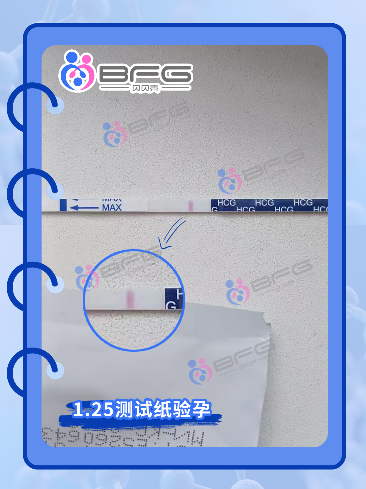 BFG助孕|一次式管，直接好孕