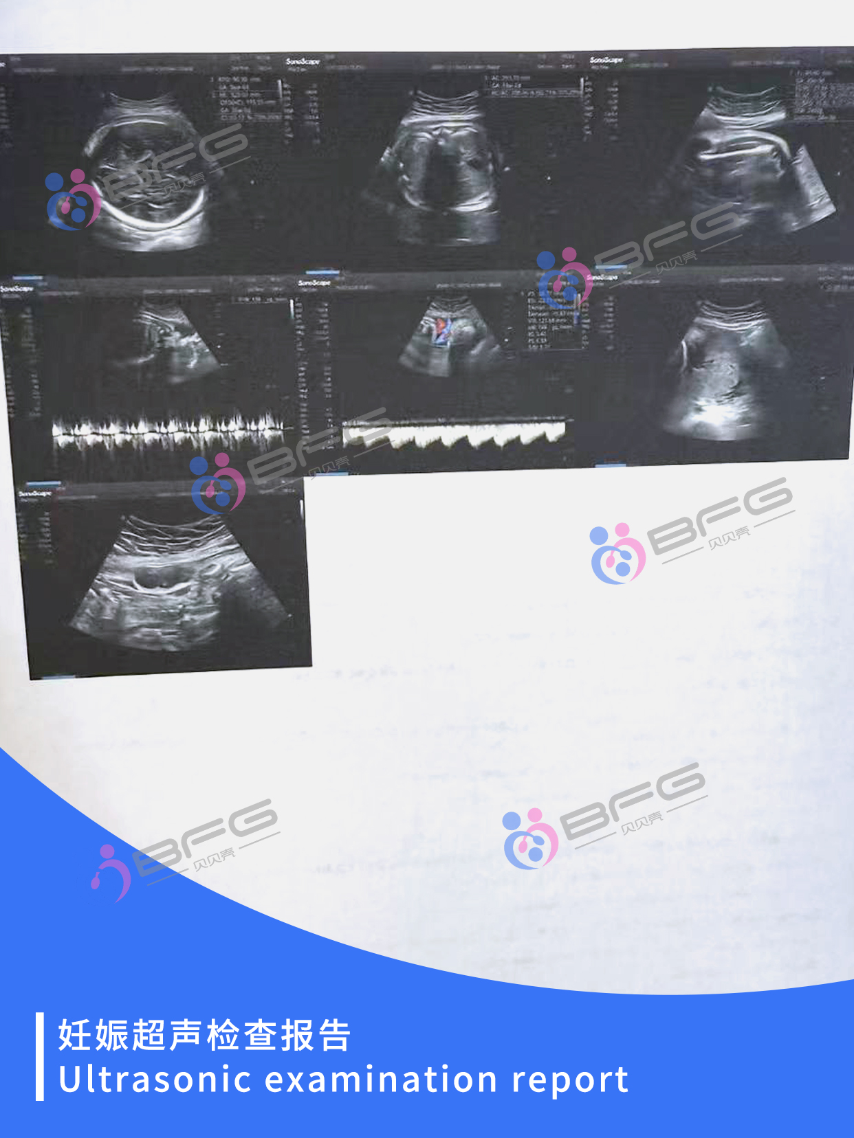 BFG助孕 | 和宝宝见面倒计时，期待~