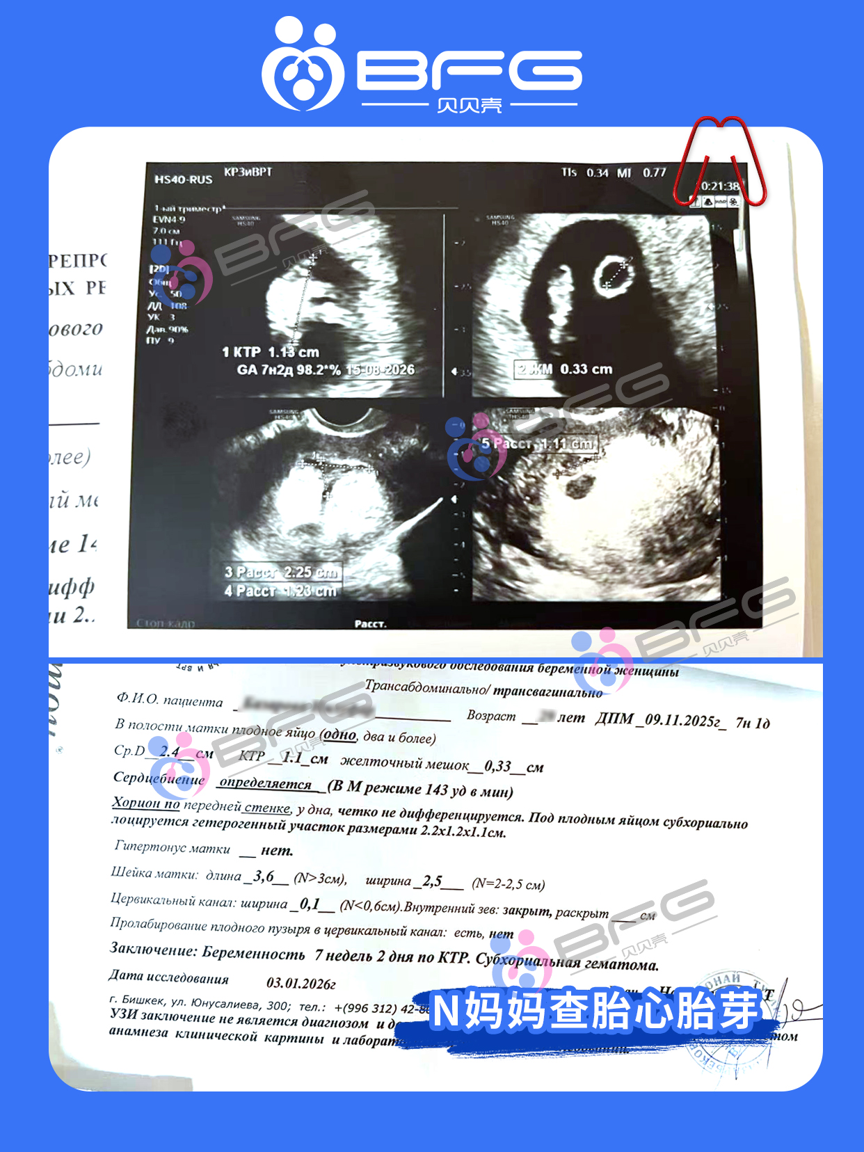 BFG助孕 | 2026年的第一声咚咚心跳