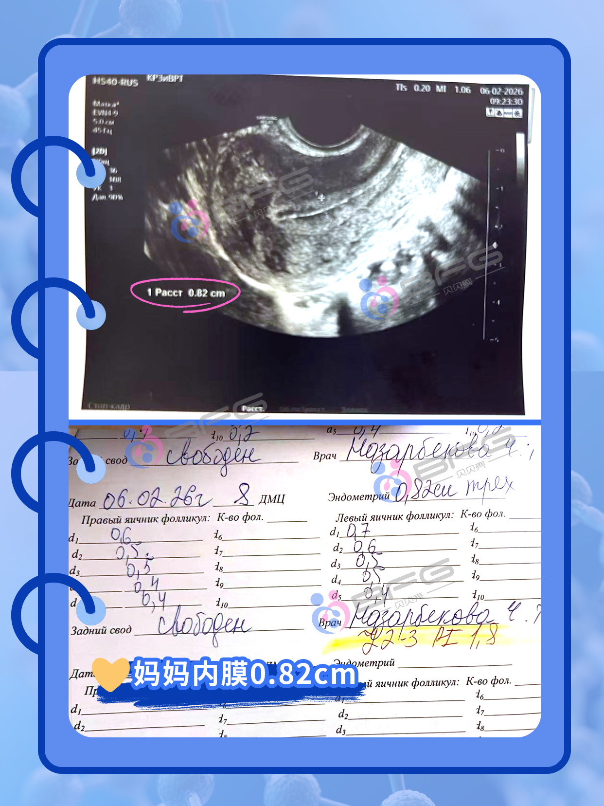 BFG助孕|科学调理内膜，提高抱娃率