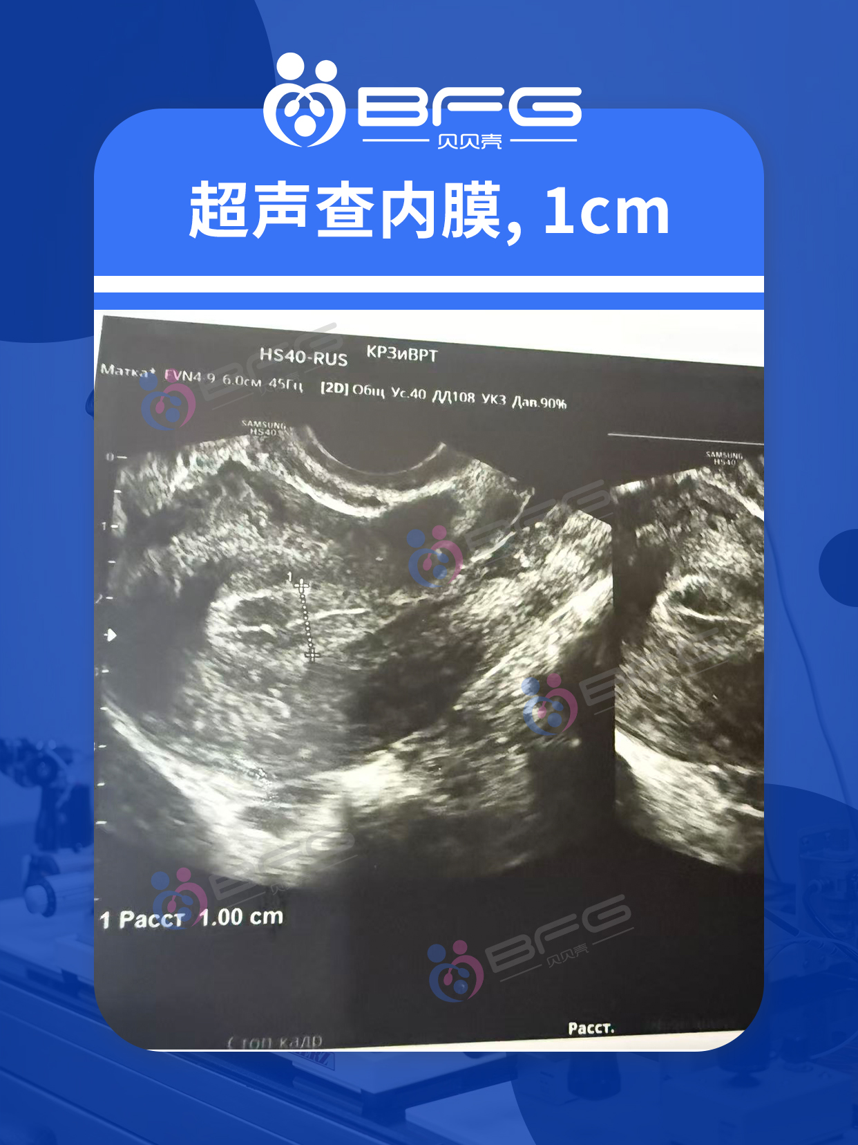 BFG助孕|Horse发生，抗体已成，静待移植