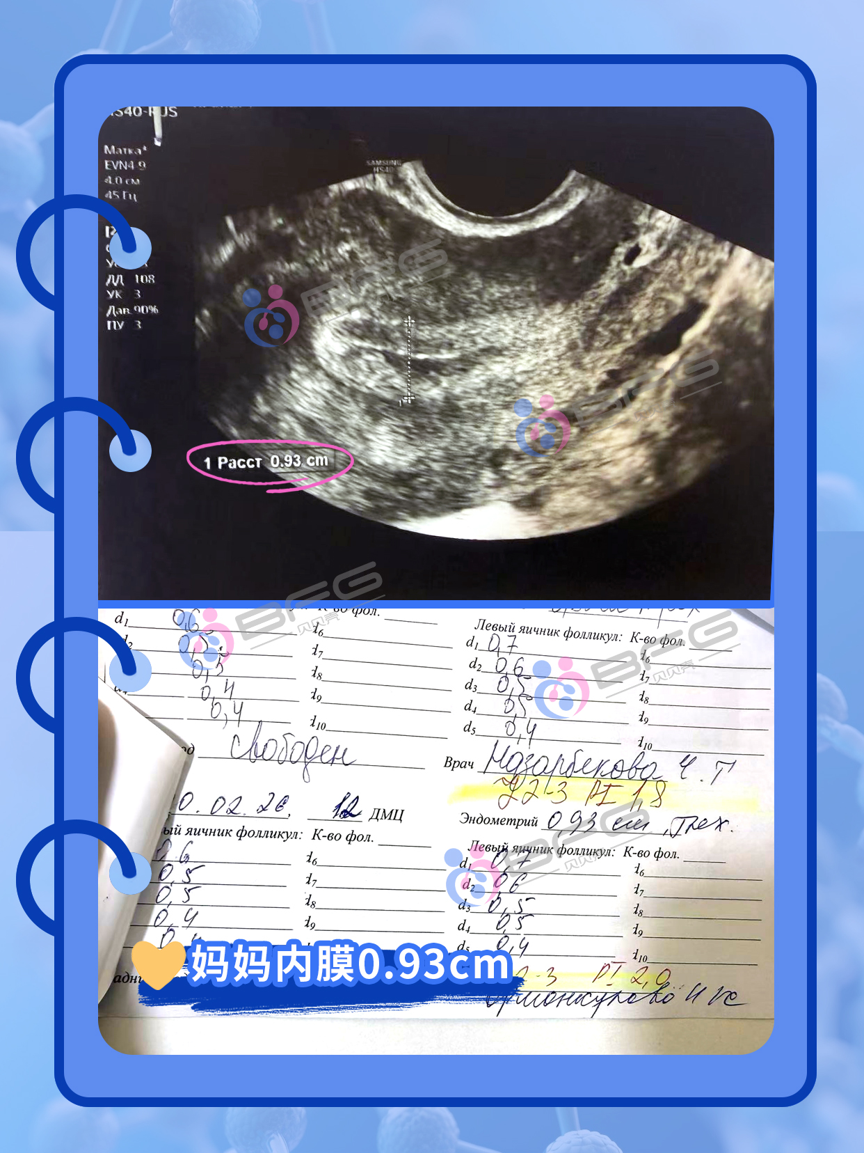 BFG助孕|科学调理内膜，提高抱娃率