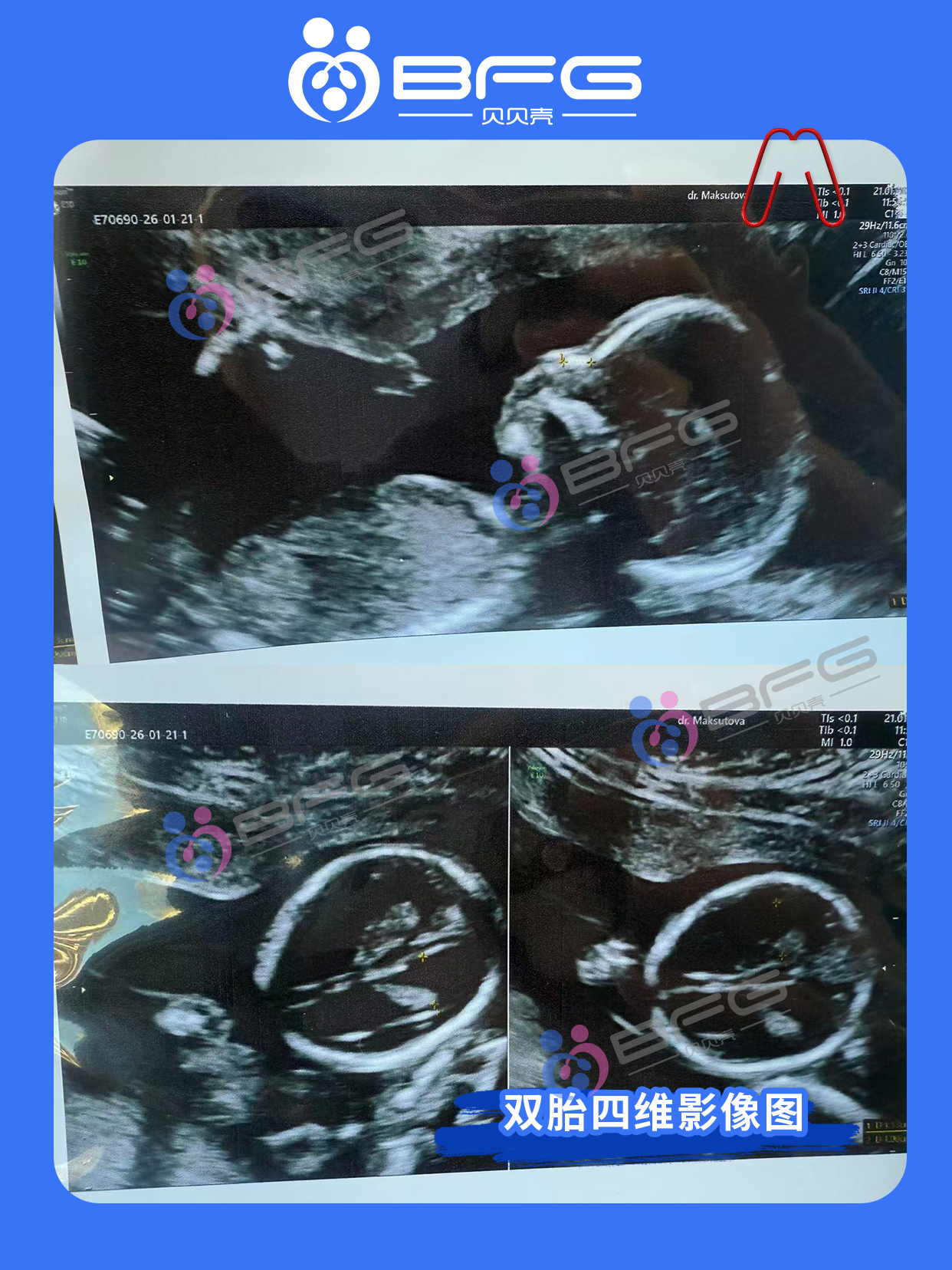 BFG助孕|四维通过，期待与两个宝宝的初见