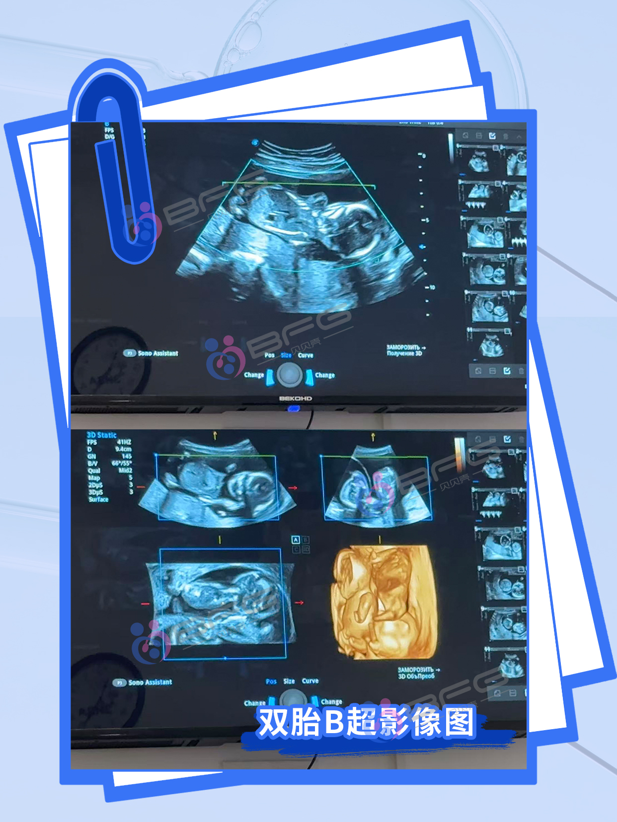 BFG助孕|“女子”事成双~龙凤胎宝宝16周啦~