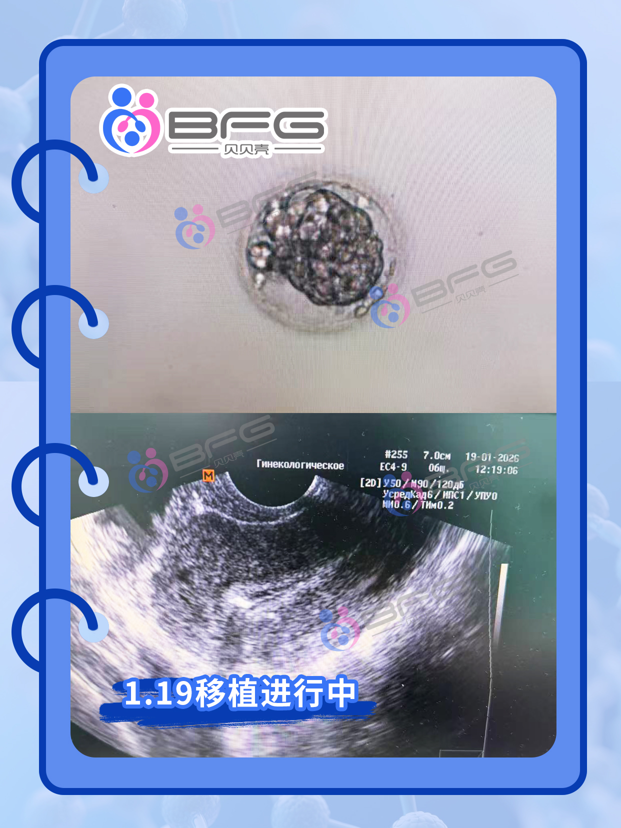 BFG助孕|一次式管，直接好孕