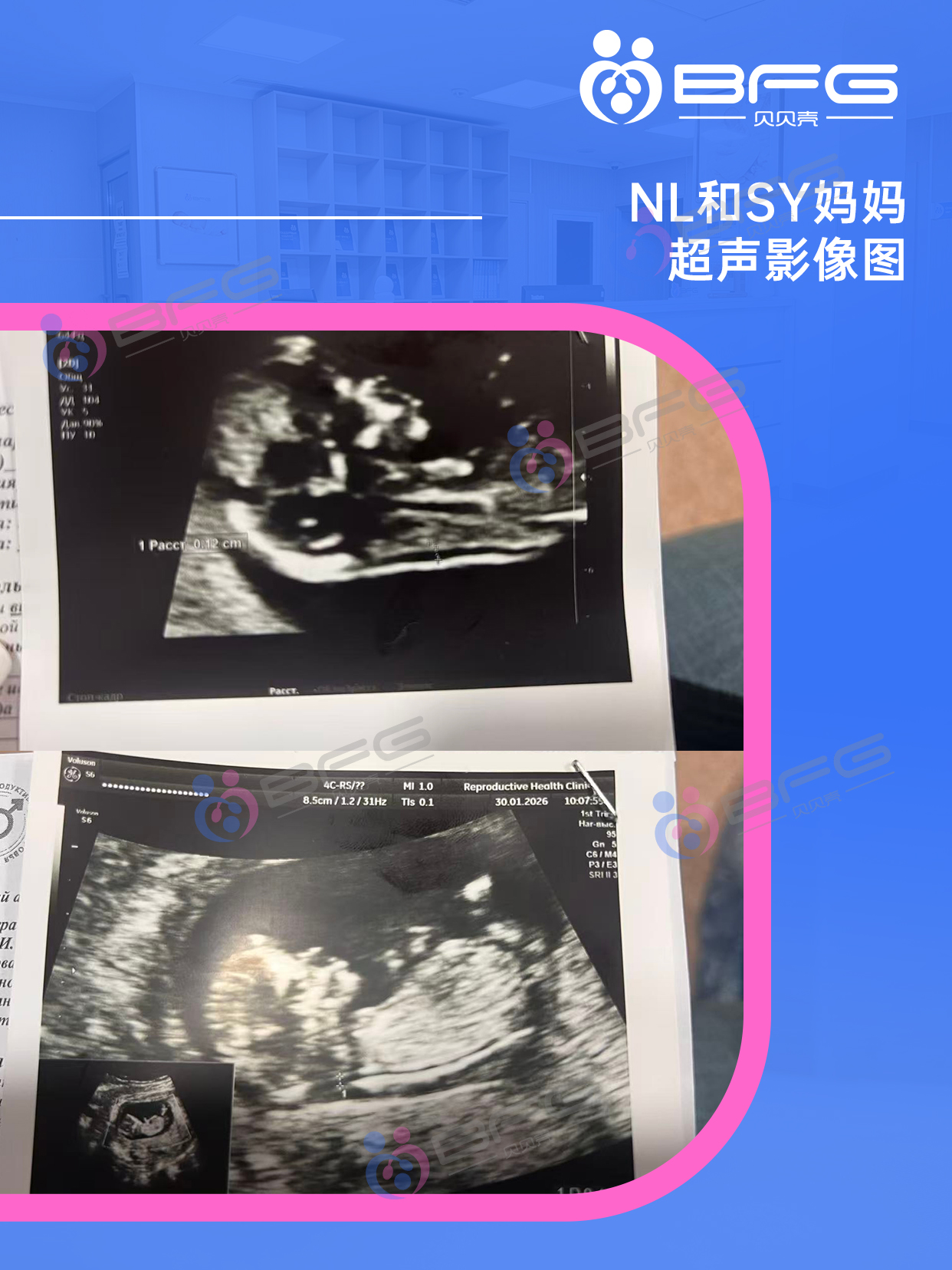 BFG助孕|Horse成双，❤妈妈同一天建档啦