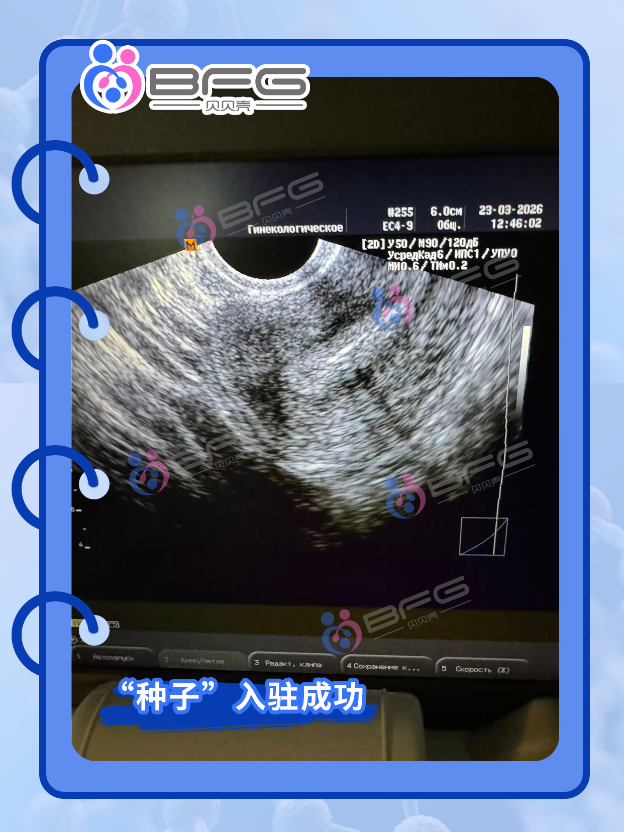 BFG助孕|❤妈妈移植顺利，静待佳音