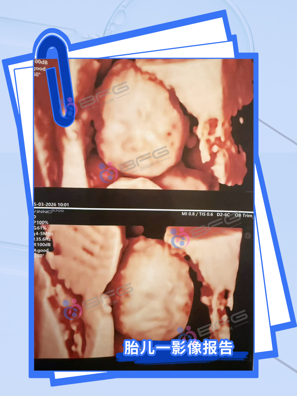 BFG助孕|龙凤宝宝，茁壮成长