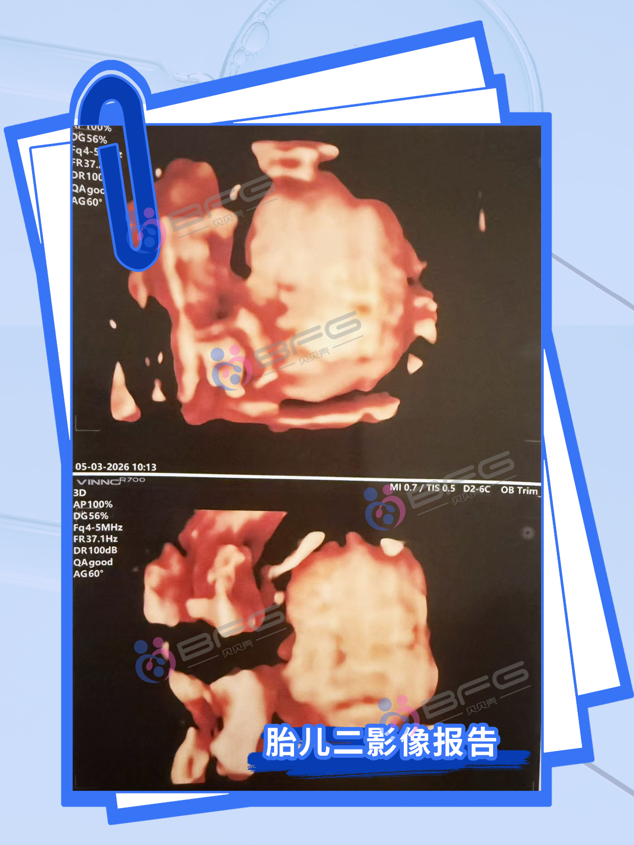 BFG助孕|龙凤宝宝，茁壮成长