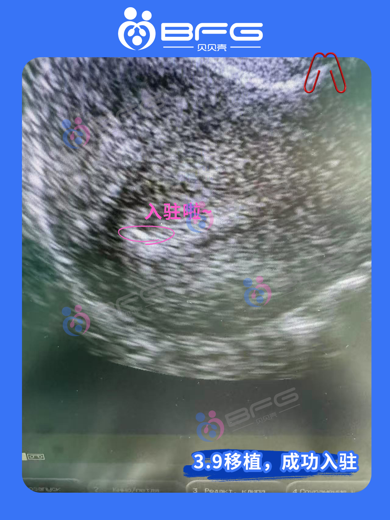 BFG助孕|HCG捷报传，小生命已安家