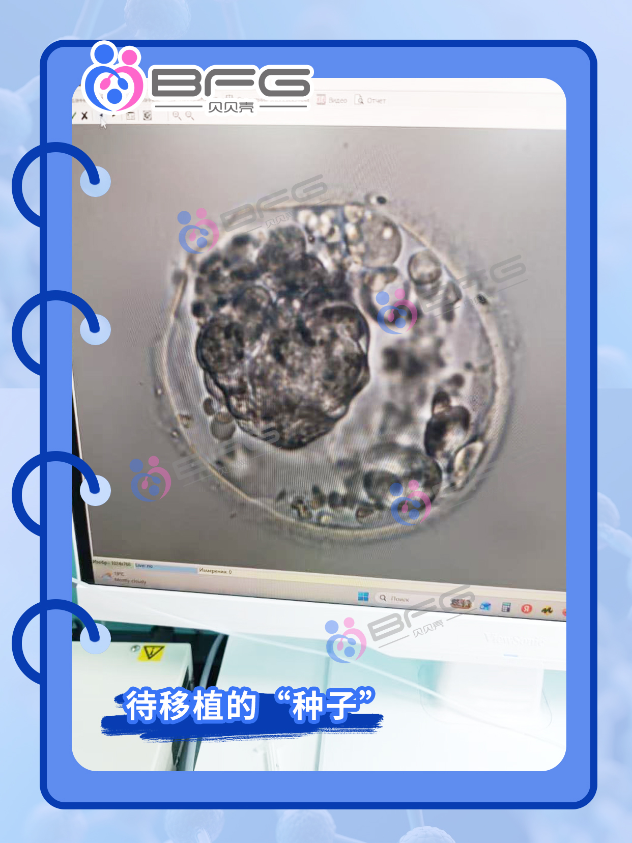 BFG助孕|❤妈妈移植顺利，静待佳音