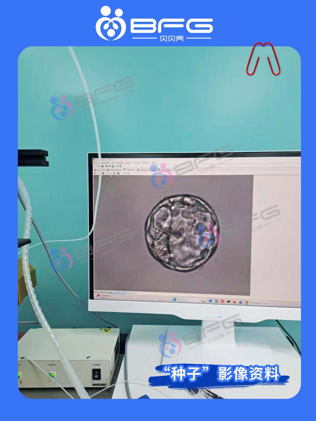 BFG助孕|HCG捷报传，小生命已安家