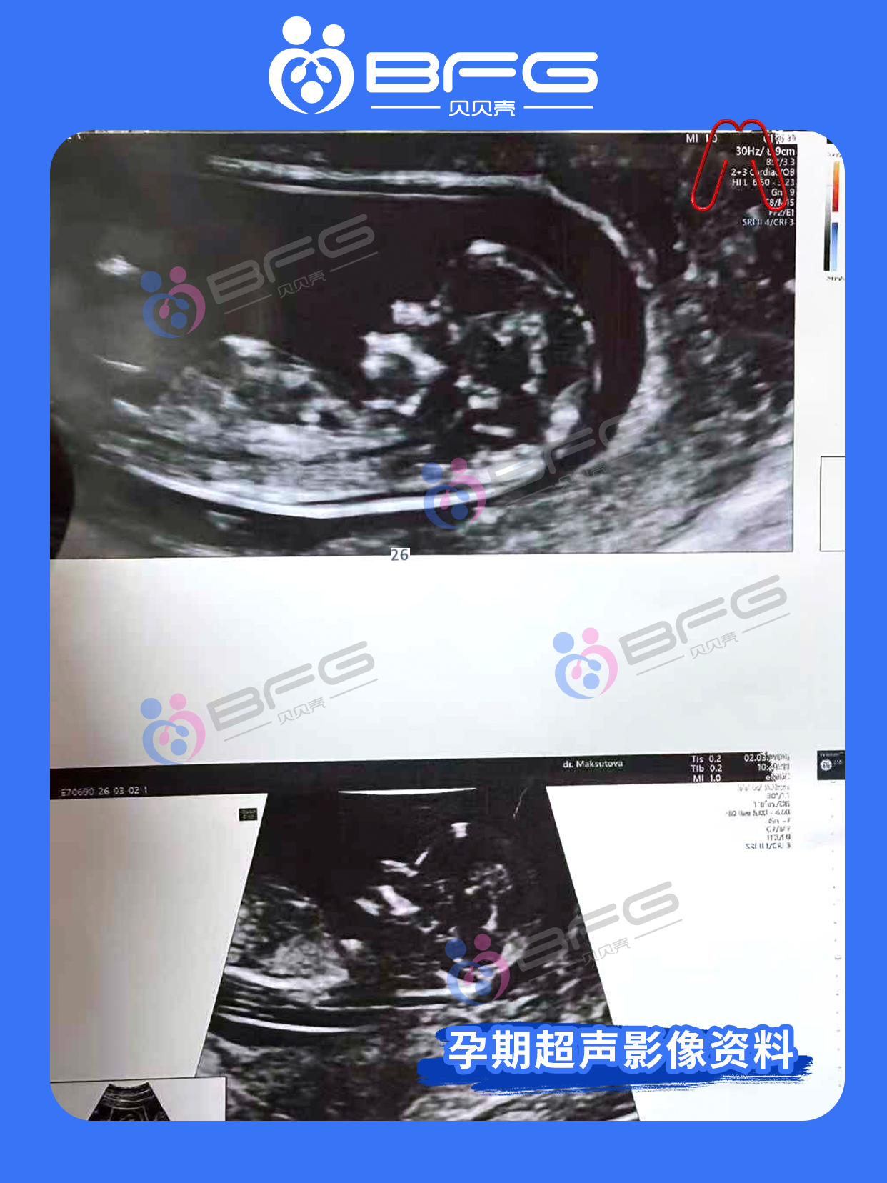 BFG助孕|3位❤妈妈，孕期三部曲