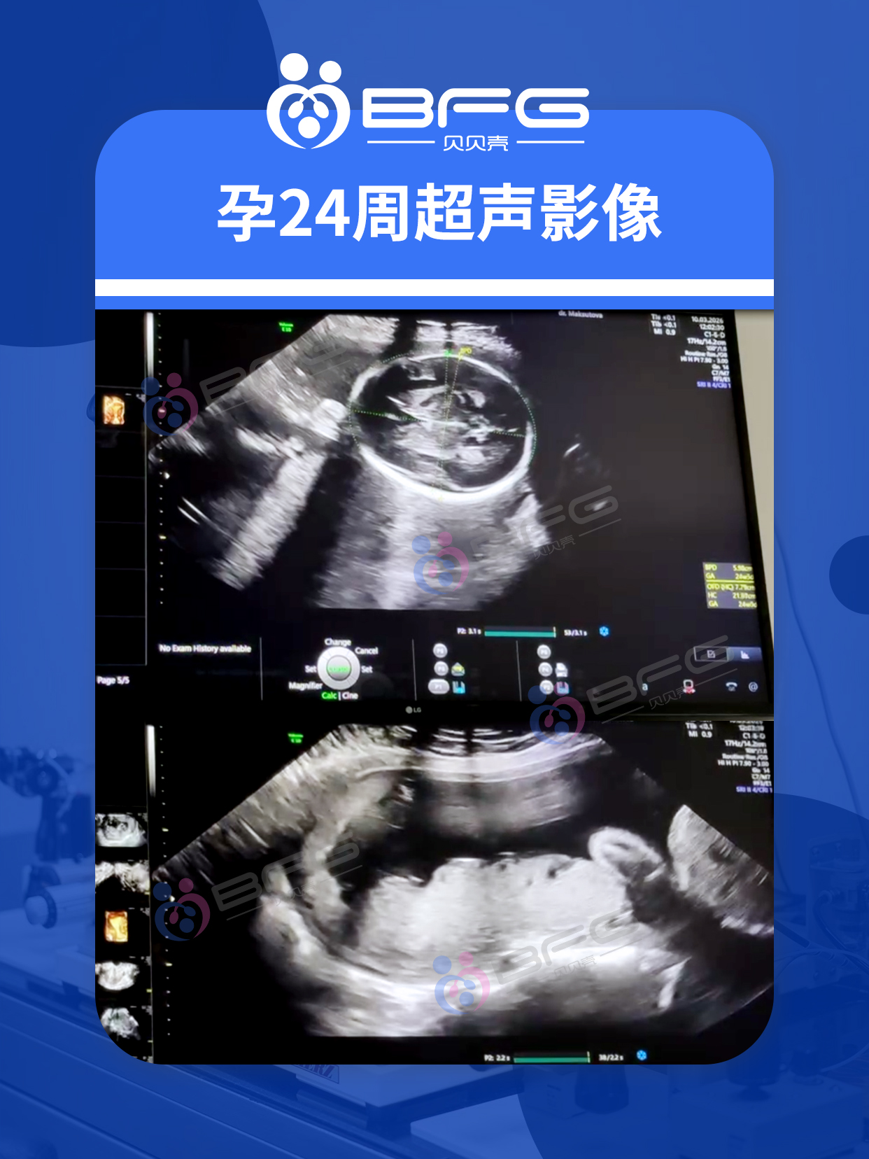 BFG助孕|吉国❤妈妈20周+24周，产检双通过